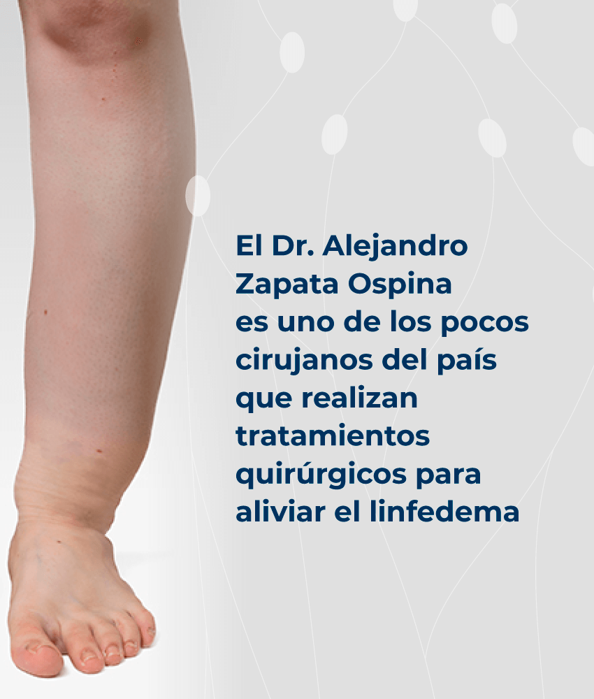 Microcirugia De Linfedema En Colombia