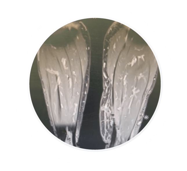 Cirugia De Linfedema Tratamiento Colombia 37