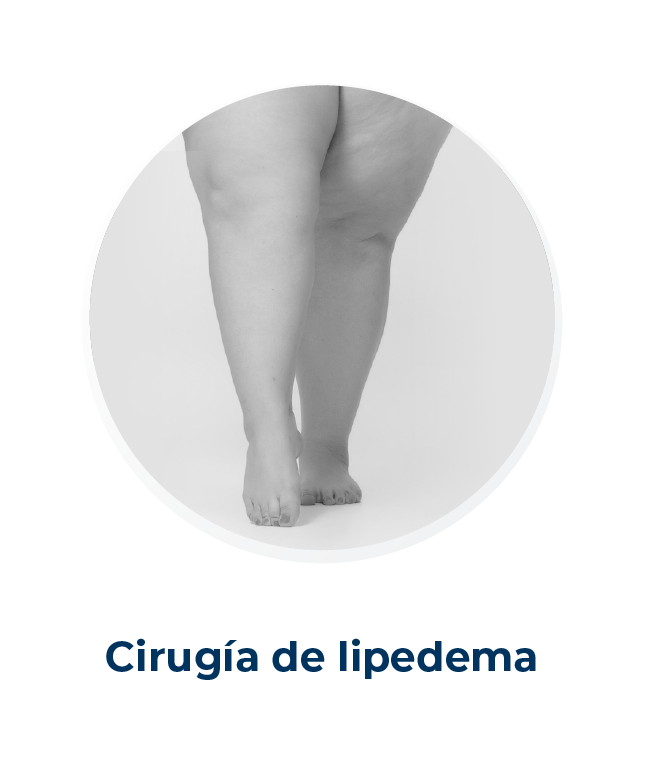 Cirujano Plastico Alejandro Zapata Linfedema Lipedema 12