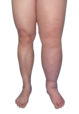 Linfedema
