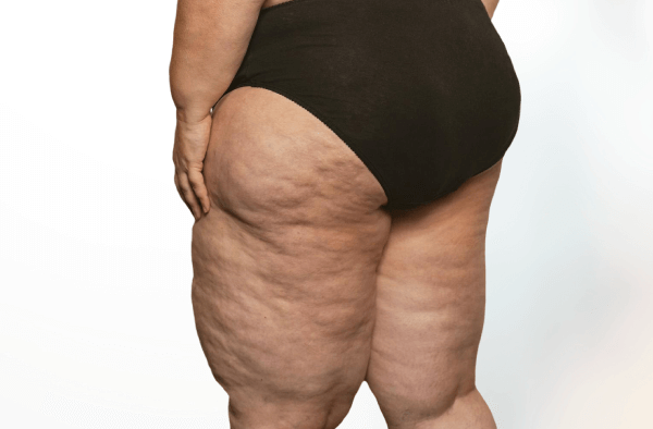 El dolor invisible del lipedema